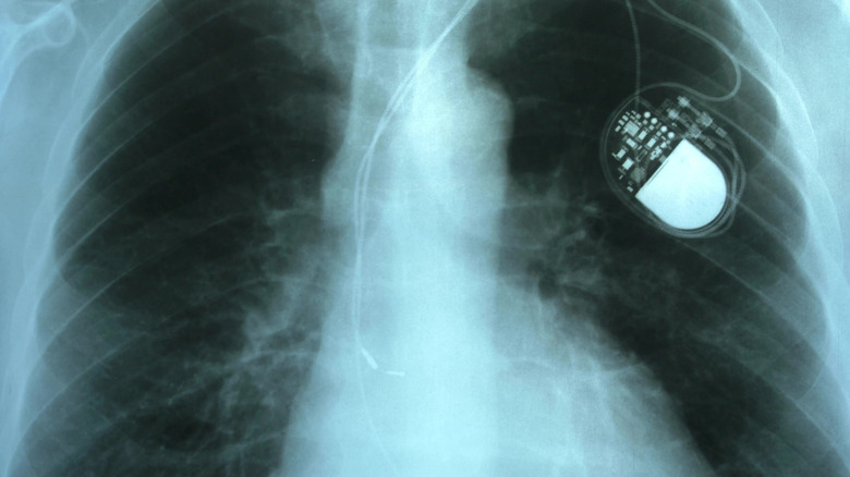 X-Ray of chest with pacemaker