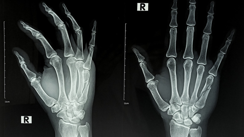 Two side by side x-rays of a hand