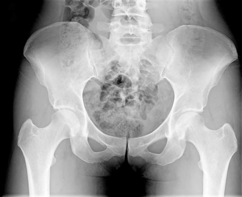 Female Pelvic / Pelivs Xray