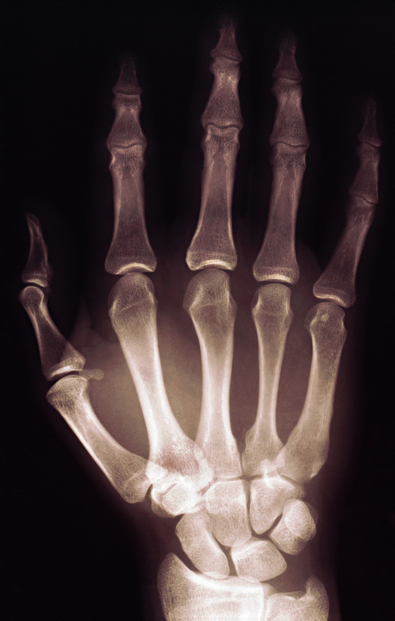 X-ray of a hand