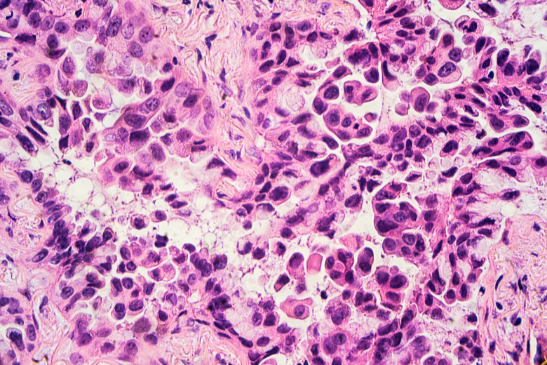 Lung Cancer: Adenocarcinoma