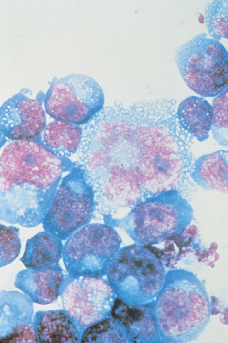 HIV-infected T-cells under high magnification