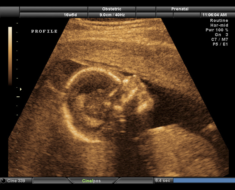 Ultra sound scan of fetus