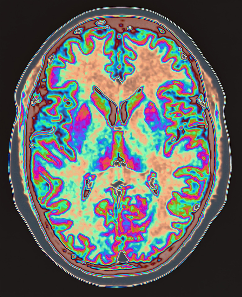 MRI scan of brain