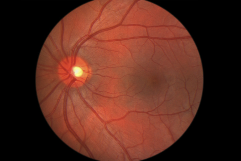 Retina Posterior Pole