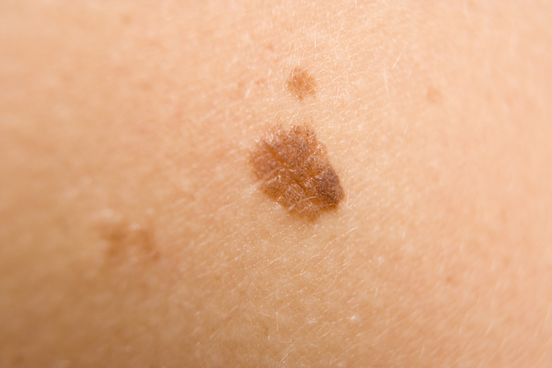 Mole on person's skin