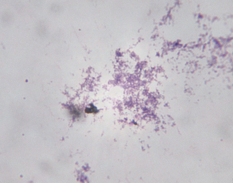 Microscopic Image of Borrelia Burgdorferi