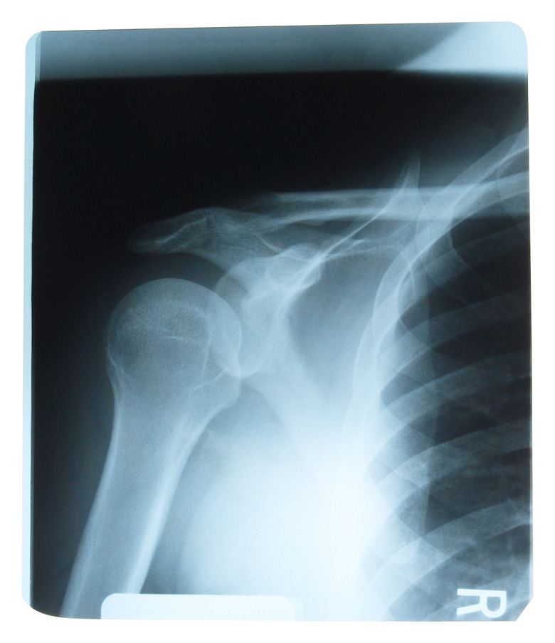 X-ray of a human shoulder