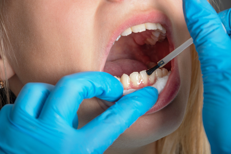 Dentistry. The patient is a teenage girl with an open mouth.